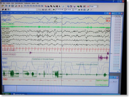 Typical Sleep Study